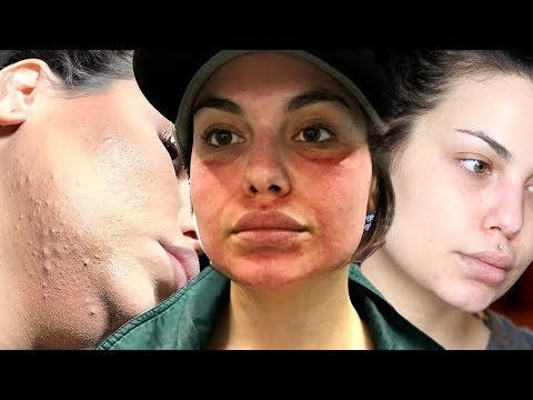 My Acne Struggle, Micro needling , Chemical Peels & Getting Clear Skin | Bailey Sarian