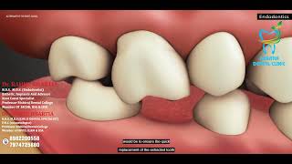 Root Canal vs Tooth Extraction (Endodontics) : Which One is Better for Your Dental Health?