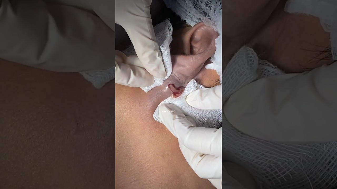 Nặn mụn nhọt ở tai, nhiều dịch mủ trắng.