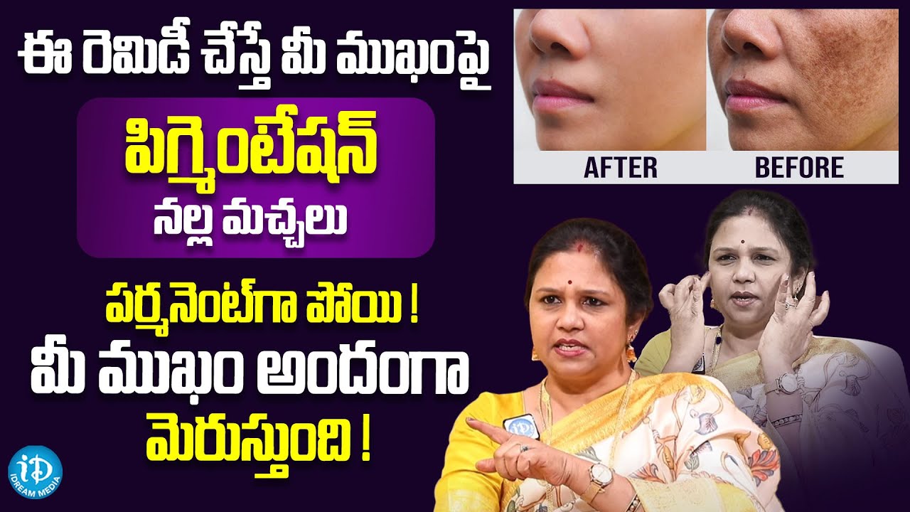 Vanaja Ramisetty About Pigmentation | Remove Black Spots, Acne and Pimples from Face | iDream