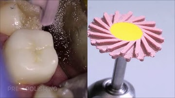 Finish the Occlusal Surface using Strauss Diamond burs