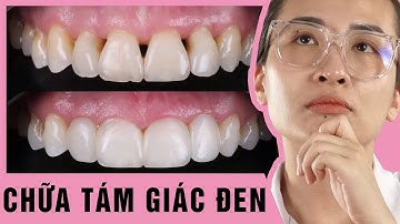 Xấu Xí TAM GIÁC ĐEN, Sửa Thế Nào Đây? | BS HỒNG NIỀNG RĂNG
