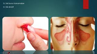 Download Burun EĞrİlİĞİ_2_5 Devİasyonun Belİrtİlerİ ? Video MP3 Burun EĞrİlİĞİ_2_5 Devİasyonun Belİrtİlerİ ?