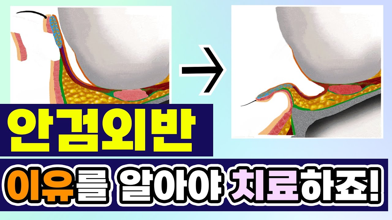 눈이 당기고 불편하다면 주목! │ 안검외반의 숨겨진 비밀 대공개