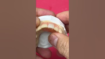 Single Anterior Nesbit Partial @EnvisiontecMain #envisiontec #short #shorts #shortvideo #shortvideos