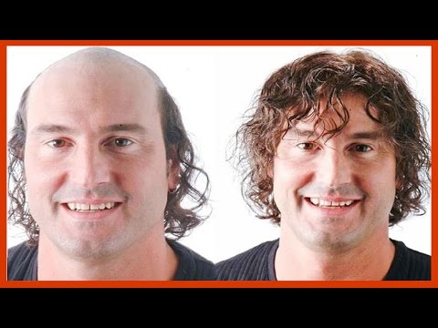 Perda do cabelo depois de tratamento de 50 anos