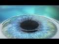 Femto LASIK Treatment Animation
