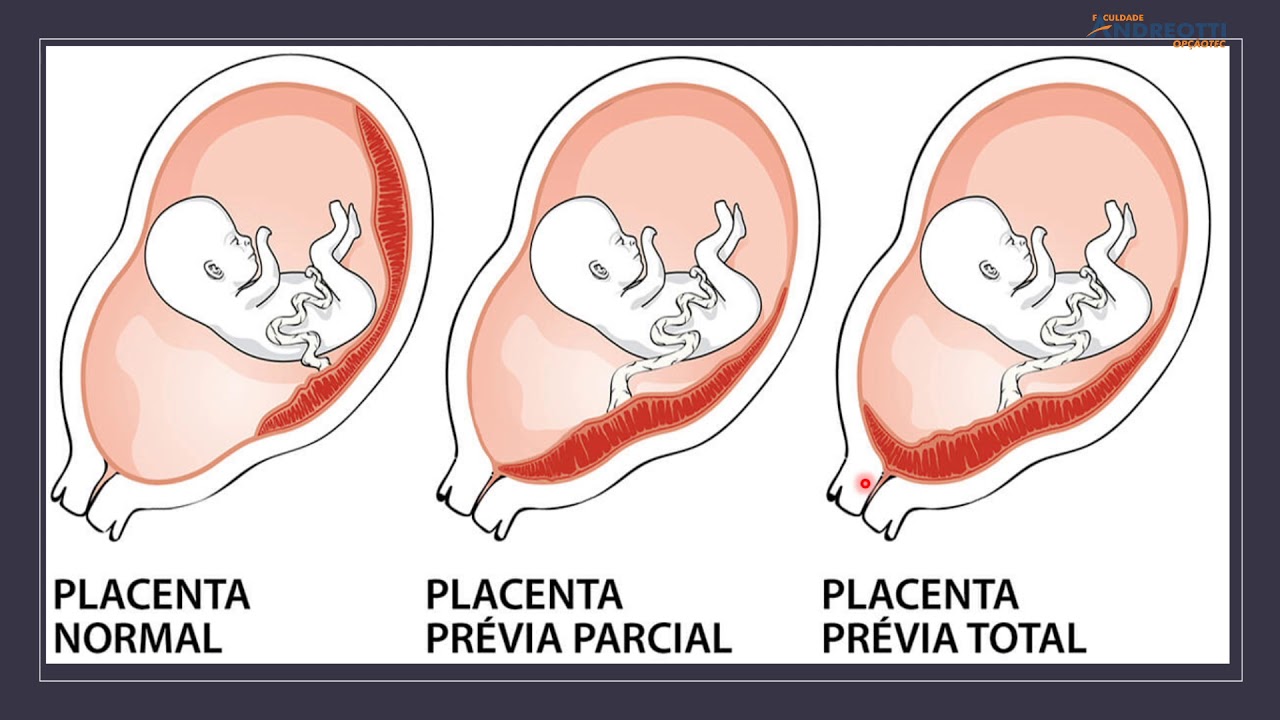Зев закрыт при беременности. Низкая плацентация. Низкая плацентация по задней стенке. Перекрывает внутренний зев.