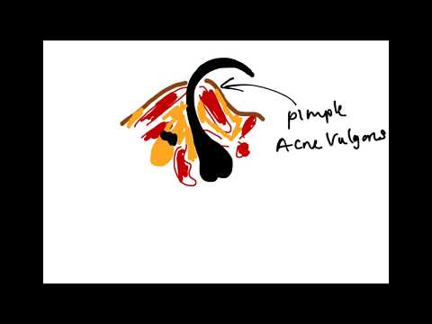 Acne Vulgaris (Pathology of Pimples & Acne)