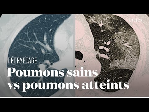 A quoi ressemblent les poumons des malades du Covid-19 ? Une interne en radiologie nous explique A quoi ressemblent les poumons des malades du Covid-19 ? Une interne en radiologie nous explique