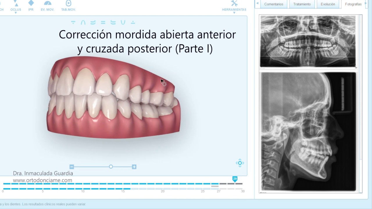 Plano De Mordida Anterior