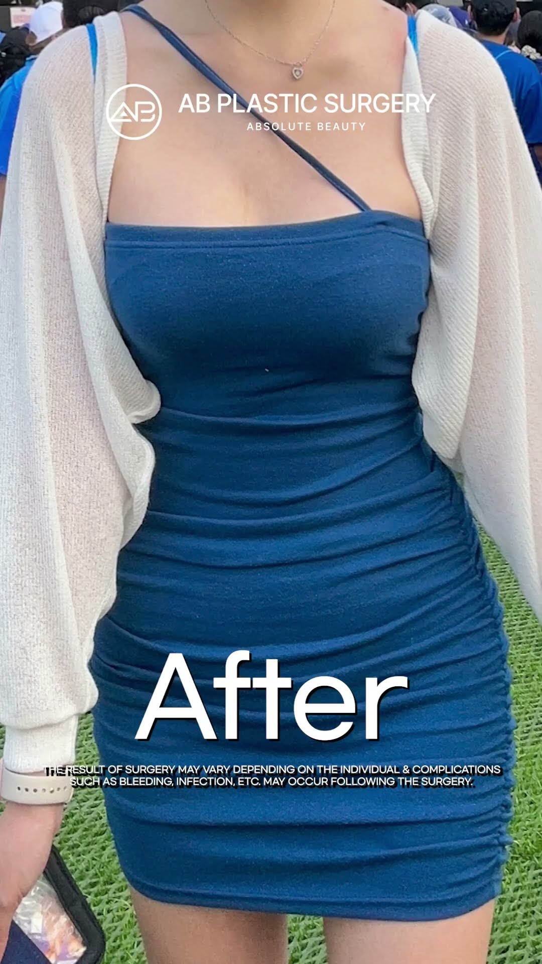 [Plastic surgery in Korea] Breast Surgery #abplasticsurgery