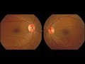 The Visual Pathway: Neuroanatomy Video Lab - Brain Dissections