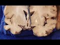 The Visual Pathway: Neuroanatomy Video Lab - Brain Dissections