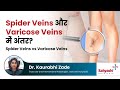 Spider Veins और Varicose Veins में अंतर? | Spider Veins vs Varicose Veins | Dr Kaurabhi Zade