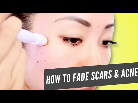 How to Use the Banish Scarring and Active Acne Kit