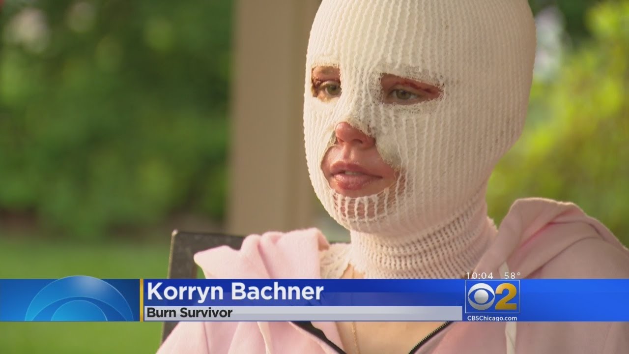 Glenbard Bonfire Burn Victim On Her Way To Recovery Youtube