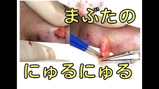 まぶたからにゅるっと脂肪が出ます【閲覧要注意】 Fat comes out of the eyelid.