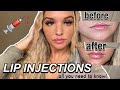 LIP INJECTIONS- before, during and after process- what you need to know
