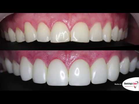 Video: ¿Pueden los lumineers alargar los dientes?