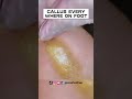 CALLUS EVERYWHERE ON FOOT 2023 [ NEVER ENDING CALLUS SCRAPING ] BY FOOT SPECIALIST MISS FOOT FIXER