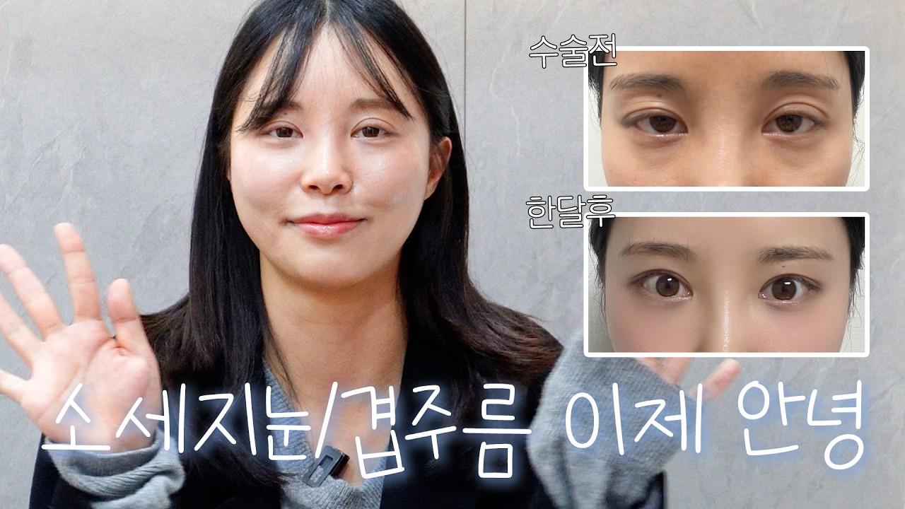 “한쪽 쌍꺼풀만 두꺼워졌어요…”🤨 쌍꺼풀+눈밑지 재수술 결심한 이유 | 에이비성형외과