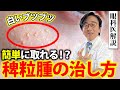 目の周りの白いブツブツ！こうやって治します。