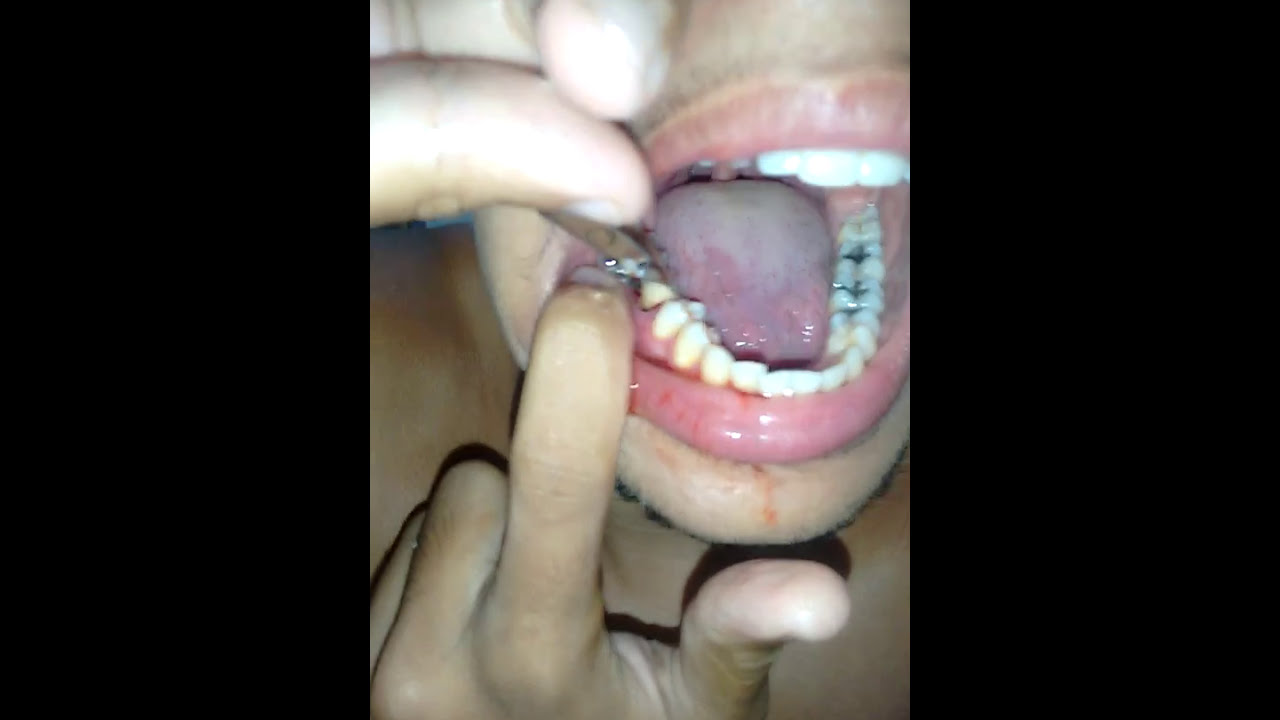 Qual Significado De Sonhar Arrancando Dente