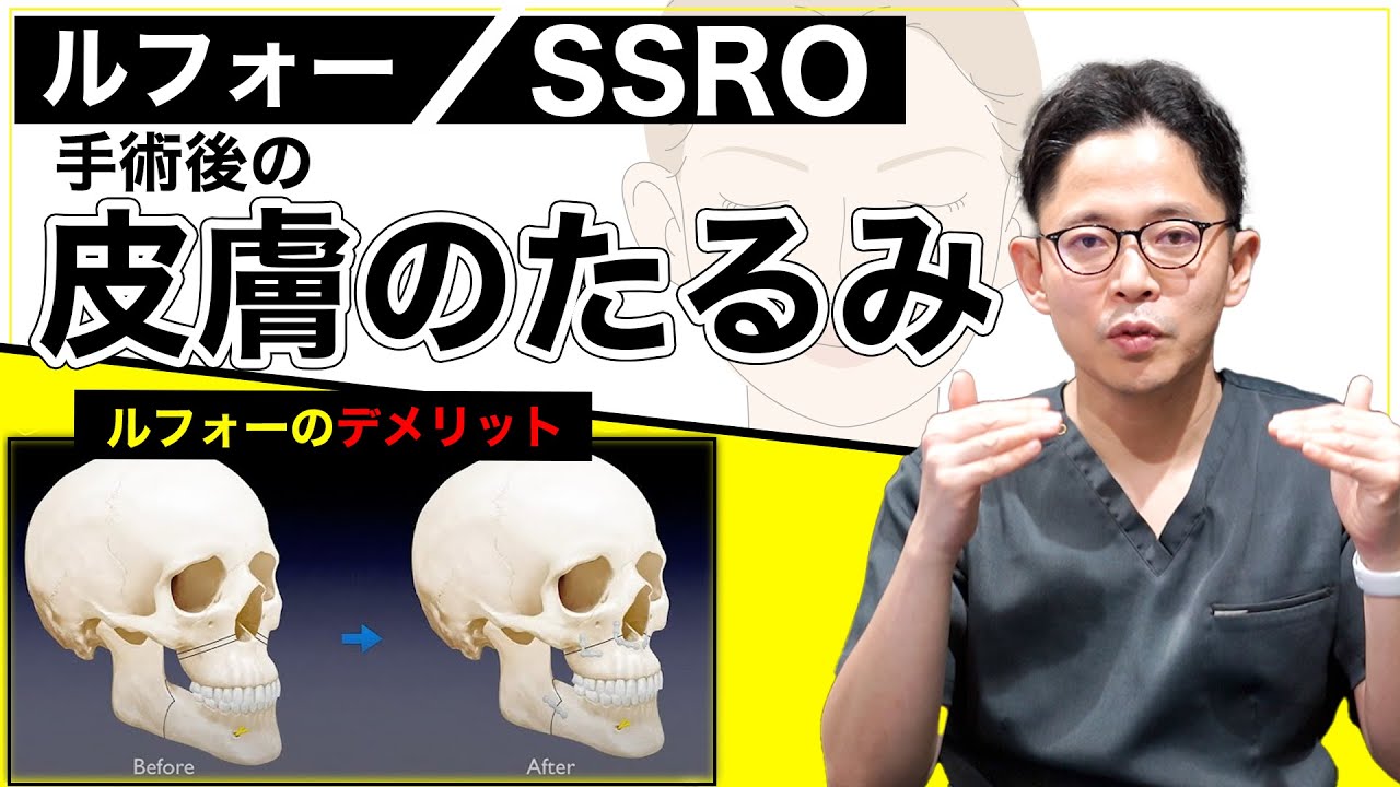 【ルフォー/SSRO】手術後の皮膚や組織のたるみはどうなる??【ルフォー/SSROのデメリット】 - YouTube
