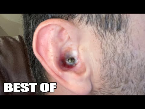 Top 10 Ear Pops!  Ear Blackheads, Pimples, Zits and Acne Popping!  Popaholics