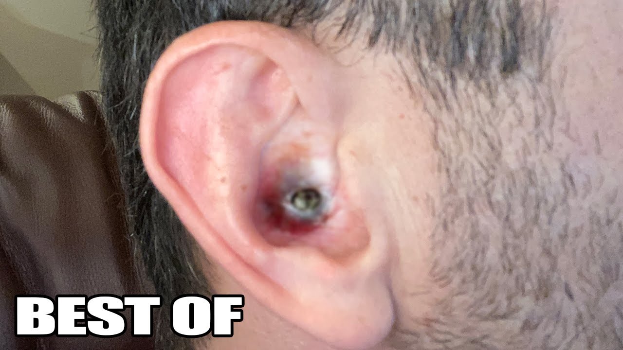 blackhead in ear