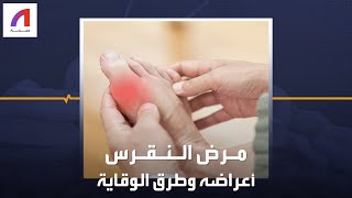 أهم أعراض مرض النقرس وطرق الوقاية منه