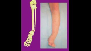 Correction of Distal Tibial Nonunion