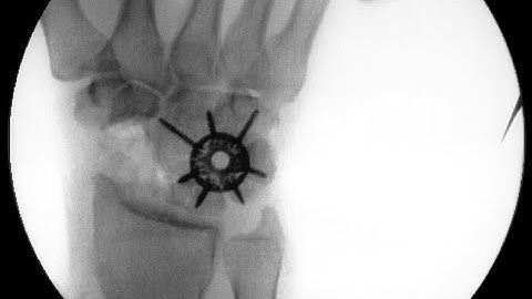 Scaphoid fracture, SNAC and SLAC wrist