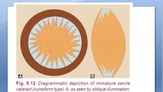 Ophthalmology 193 Cortical Senile Cataract Incipient Immature Mature HyperMature Morgagnian Soft screenshot 3