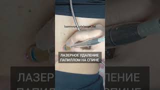 Лазерное удаление папиллом на спине!! Быстро!!!