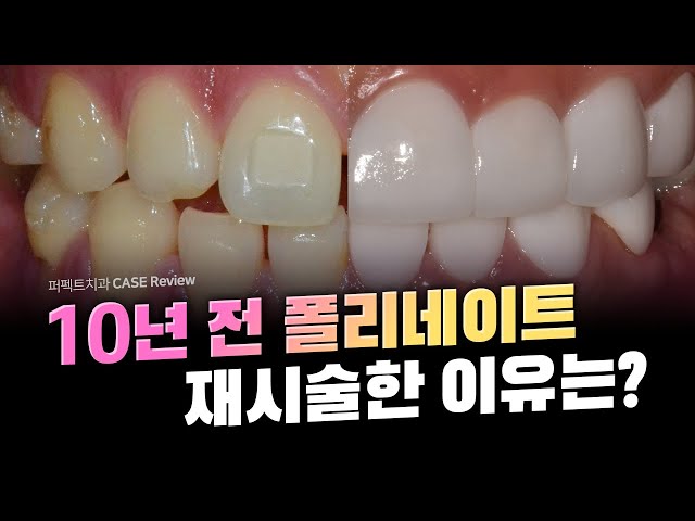 10년전에 왔던.. 무삭제 라미네이트 재시술 또??