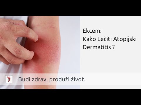 Ekcem: Kako Lečiti Atopijski Dermatitis ?