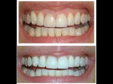 Best home teeth whitening strips for women using Stella White 