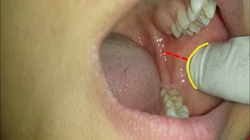 Inferior alveolar nerve block
