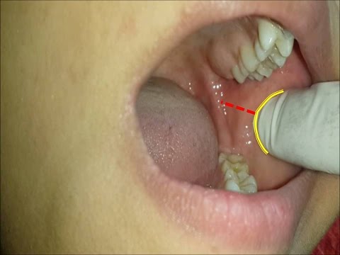 Inferior alveolar nerve block