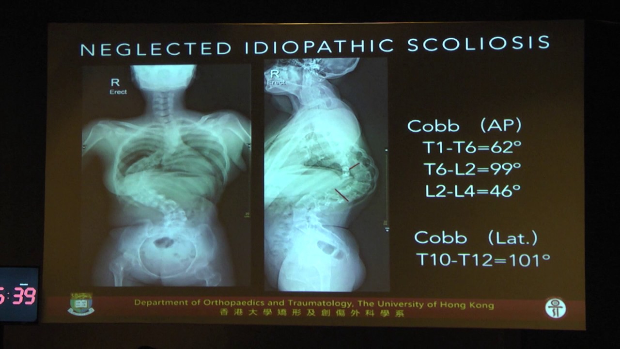 (32) - Osteotomías en escoliosis idiopática [DR Kin Cheung Mak] - YouTube