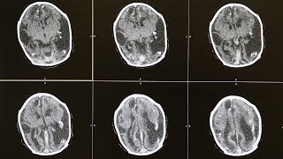 ¿Cuáles son las principales discapacidades que causa un derrame cerebral?