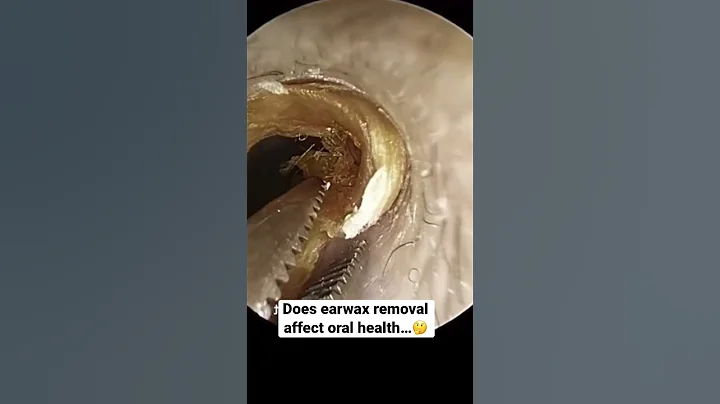 Earwax Removal Can Do THIS For Your Oral Health!?!...