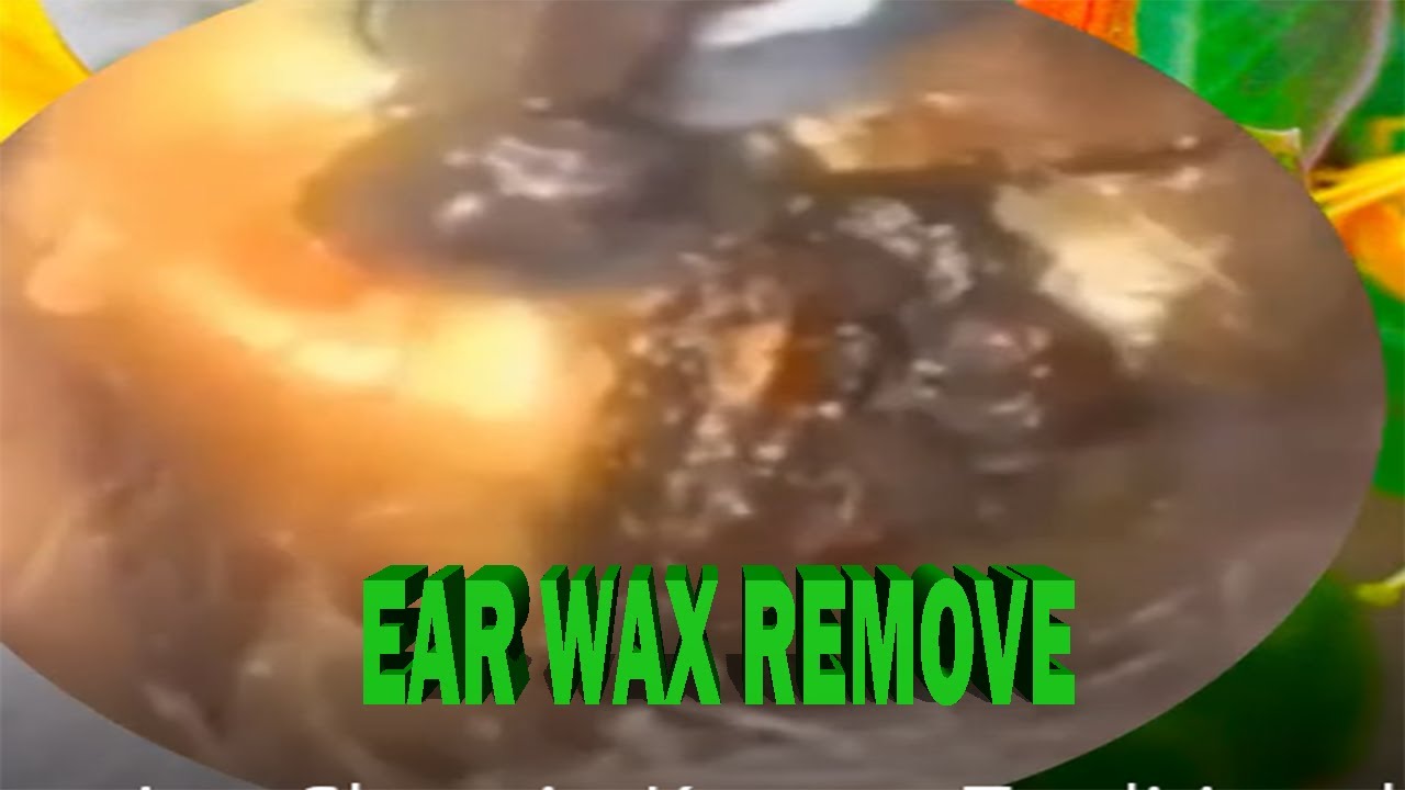 IMPACTED EAR WAX STONY HARD REMOVAL ear wax remove SpaEP102 YouTube