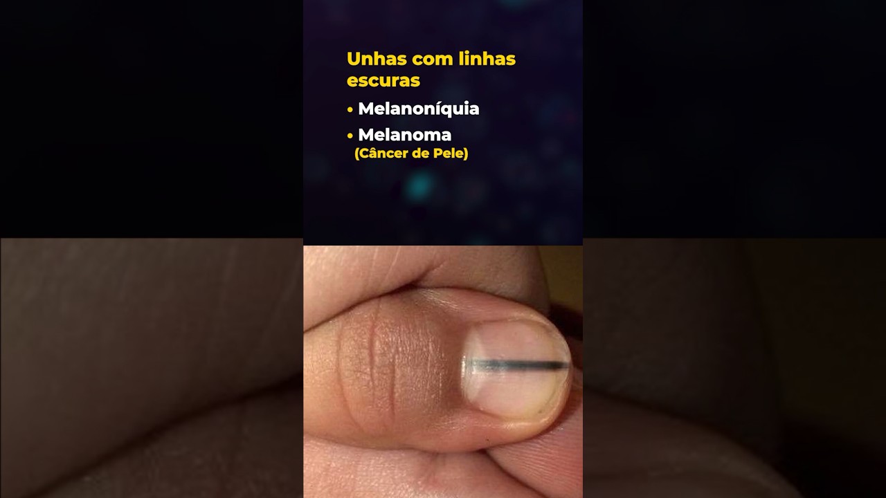 CÂNCER na UNHA EXISTE? Veja como identificar! #medicoexplica #cancer #unha #unhas