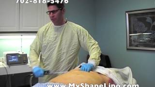 Myshape Lipo Advanced Tumescent Laser Liposuction Training Course, Abdominal Liposuction