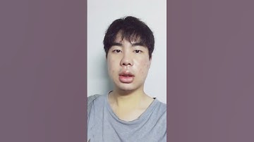 Two jaw surgery for men : Korea plastic surgery #shorts