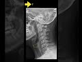 Testing cervical anatomy (X-rays) Part B #shorts