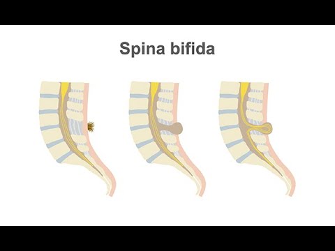 Managing spina bifida